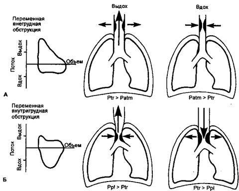 Реферат: Обструкция дыхательных путей