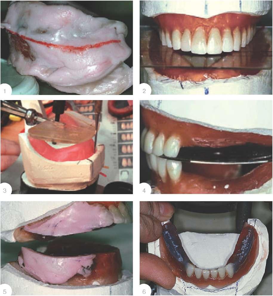 Анатомический принцип постановки зубов по стеклу