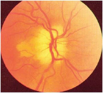 Передняя ишемическая нейропатия. Оптическая нейропатия Лебера. Токсическая нейропатия зрительного нерва. Передняя ишемическая нейропатия глазное дно. Височный артериит глазное дно.