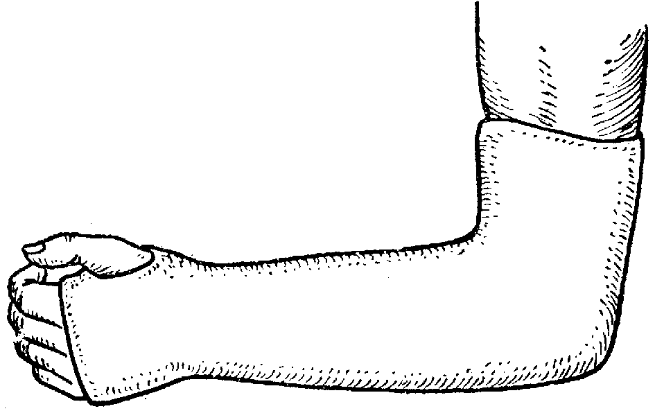 Первые гипсовые повязки. Лонгетно-циркулярная гипсовая. Перелом локтевого отростка лонгета. Перелом венечного отростка локтевой кости гипс. Лонгетно-циркулярная гипсовая повязка.