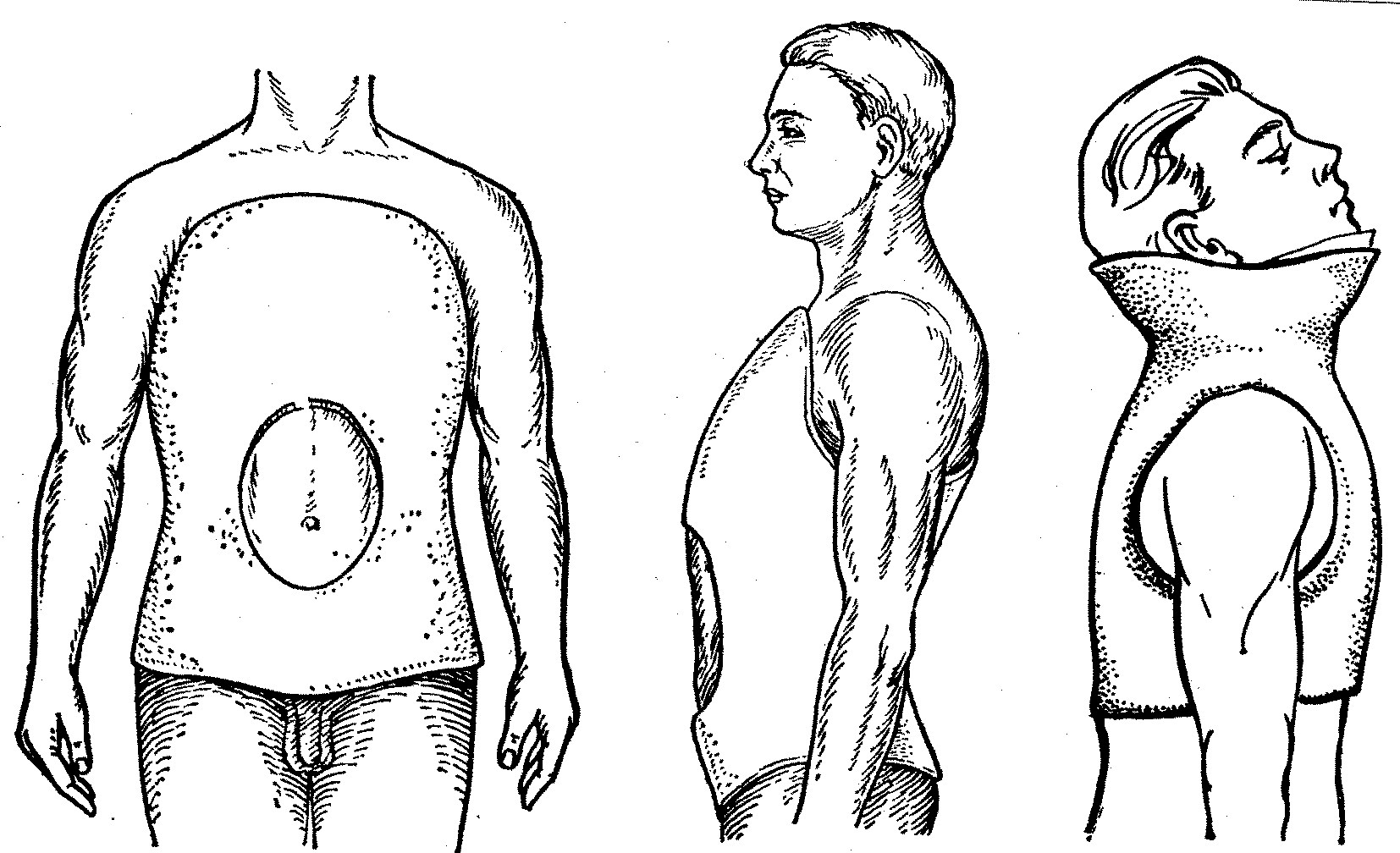 Первые гипсовые повязки