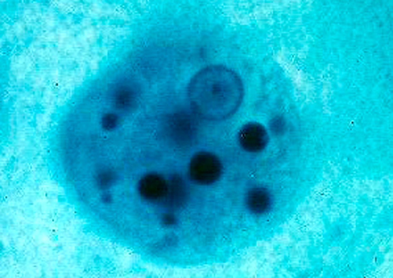 Заболевания вызванные амебами. Entamoeba histolytica циста. Трофозоит дизентерийной амебы. Дизентерийная амёба микрофотография.