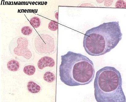1 плазматическая клетка. Плазматические клетки плазмоциты. Плазматические клетки мазок. Плазматические клетки в выпотной жидкости. Плазматические клетки гистология.