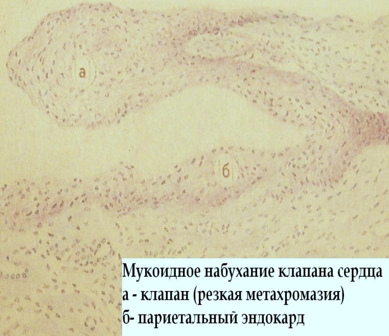 Гиалиноз относится к. Мезенхимальная углеводная дистрофия. Мезенхимальная жировая дистрофия это. Мезенхимальные белковые дистрофии. Мукоидное фибриноидное набухание гиалиноз.