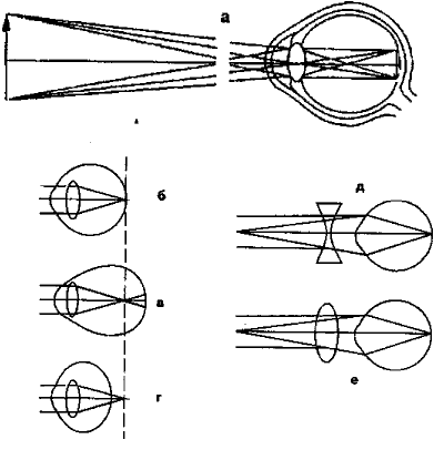 Установите соответствие между типом глаза ходом лучей в них и способом коррекции изображения