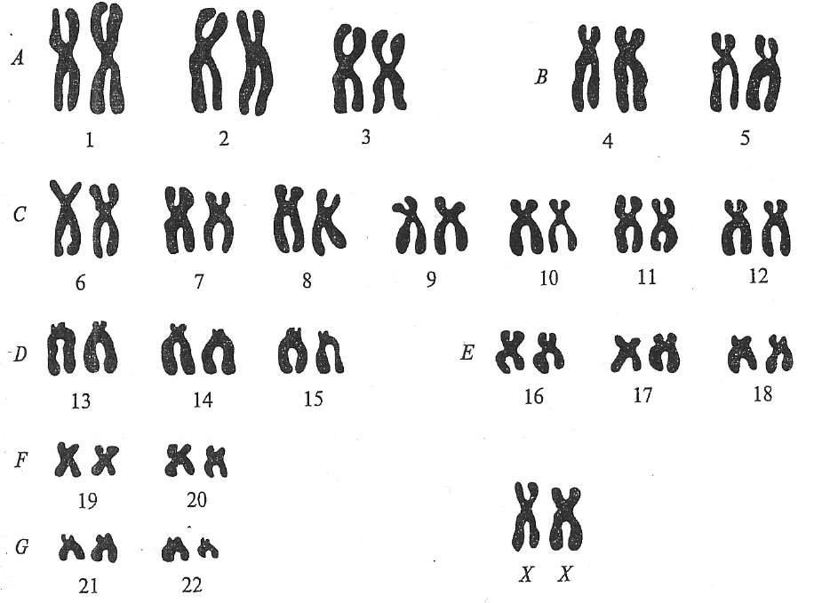 46 хромосом 1. Нормальный кариотип человека 46 хромосом. Идиограмма хромосом человека. Хромосомный набор кариотип человека. Кариотип Гоше.