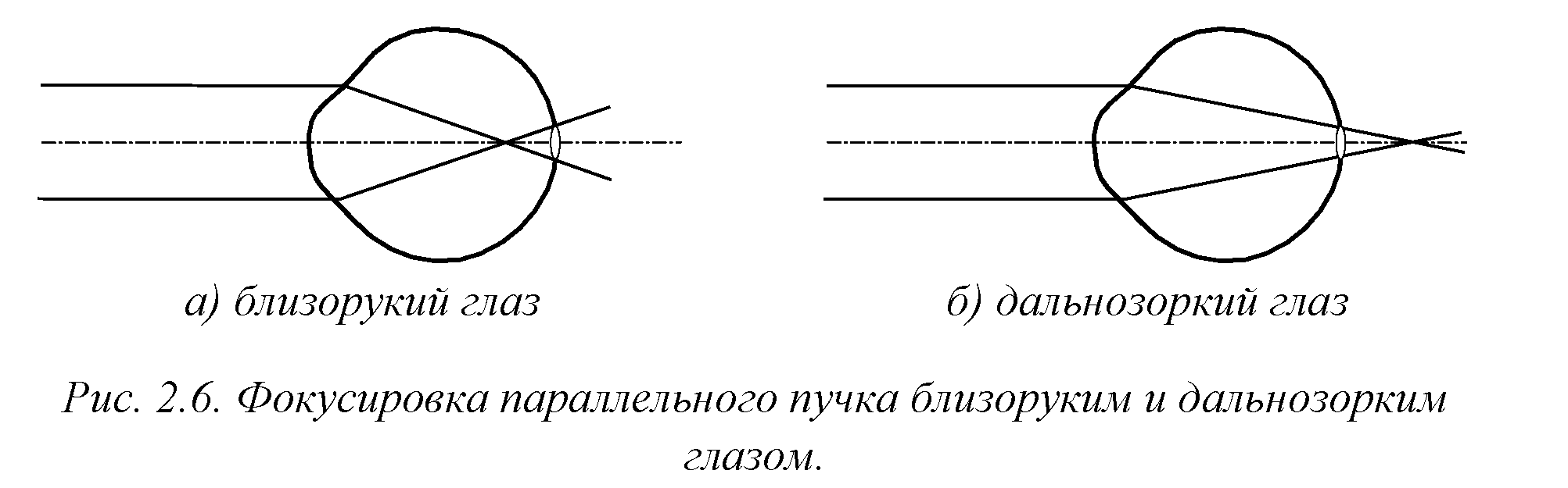 Какие дефекты зрения изображены на рисунках предложите дорисуйте способы их исправления