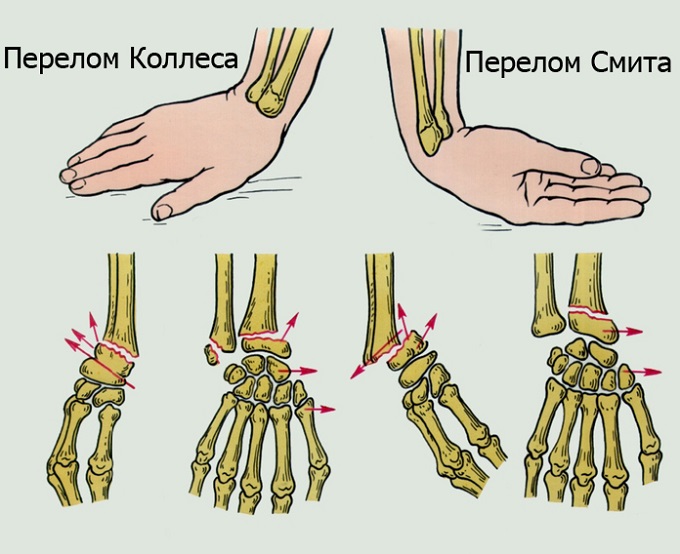 отек пальцев при переломе лучевой кости