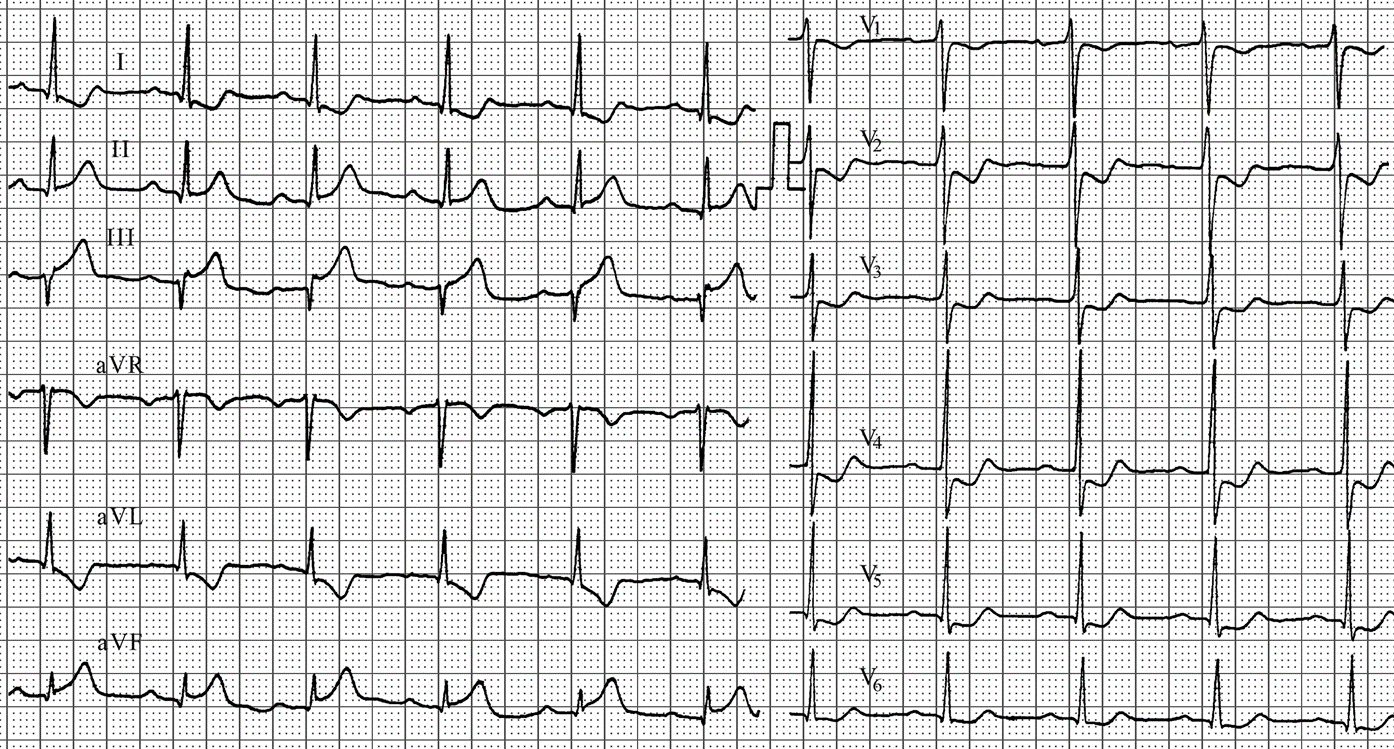 Очаговые изменения левого желудочка. V4-v6 ЭКГ стенка. Заднедиафрагмальный инфаркт миокарда ЭКГ. Нижнебоковой инфаркт миокарда на ЭКГ. Острый Нижний (заднедиафрагмальный) инфаркт миокарда ЭКГ.