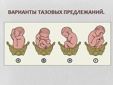 Причины тазового предлежания. Маловодие тазовое предлежание. Полное и неполное ножное предлежание. Предлежание плодов при многоплодной беременности.