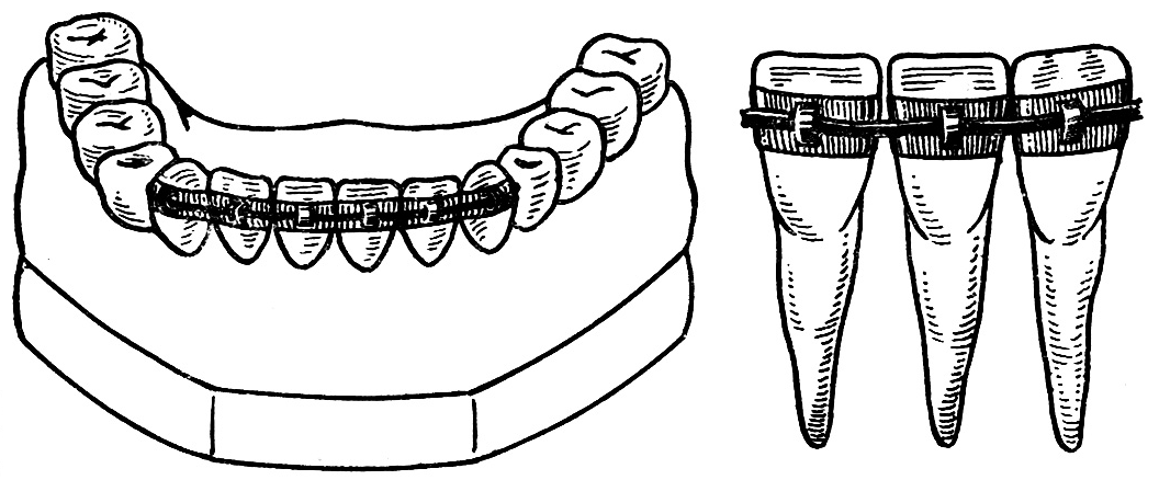 Кольцевая шина. Шинирование в ортопедической стоматологии. Армированная экстракоронковая шина. Временное и постоянное шинирование при пародонтите. Временное шинирование при пародонтите.