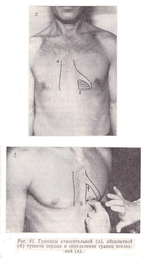 Относительная тупость сердца. Относительная тупость сердца перкуссия норма. Оценка границ сердечной тупости. Границы абсолютной тупости сердца. Относительная и абсолютная тупость сердца.