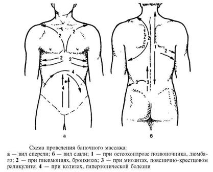 Баночный массаж спины схема